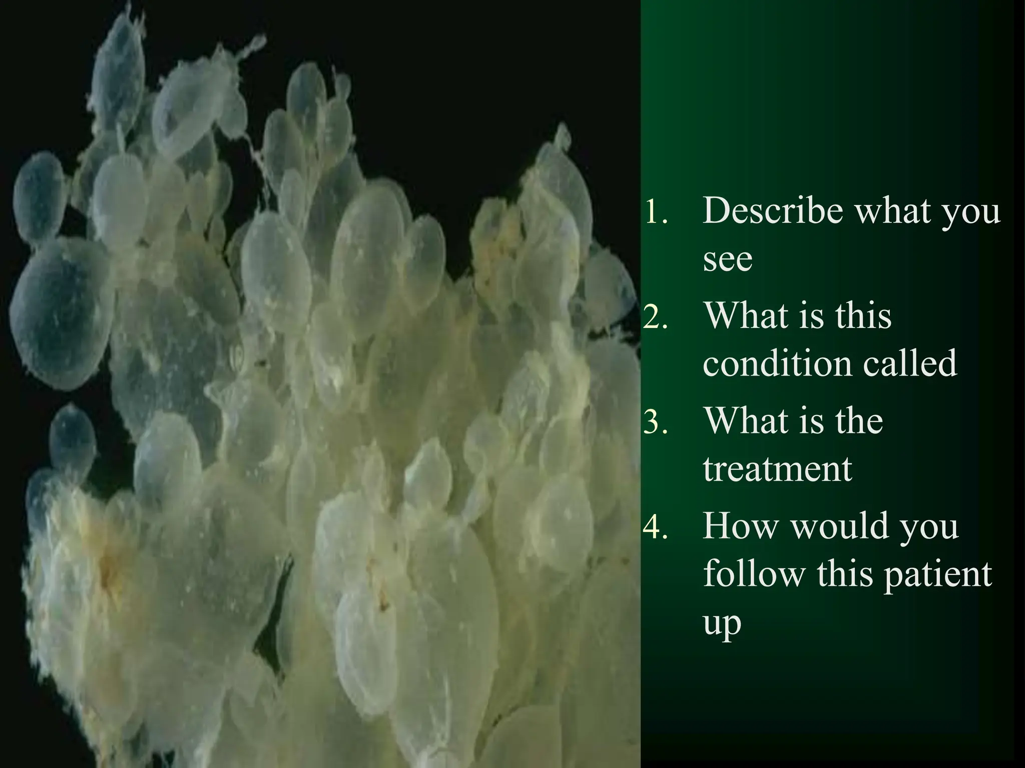 1
1. Describe what you
see
2. What is this
condition called
3. What is the
treatment
4. How would you
follow this patient
up
 