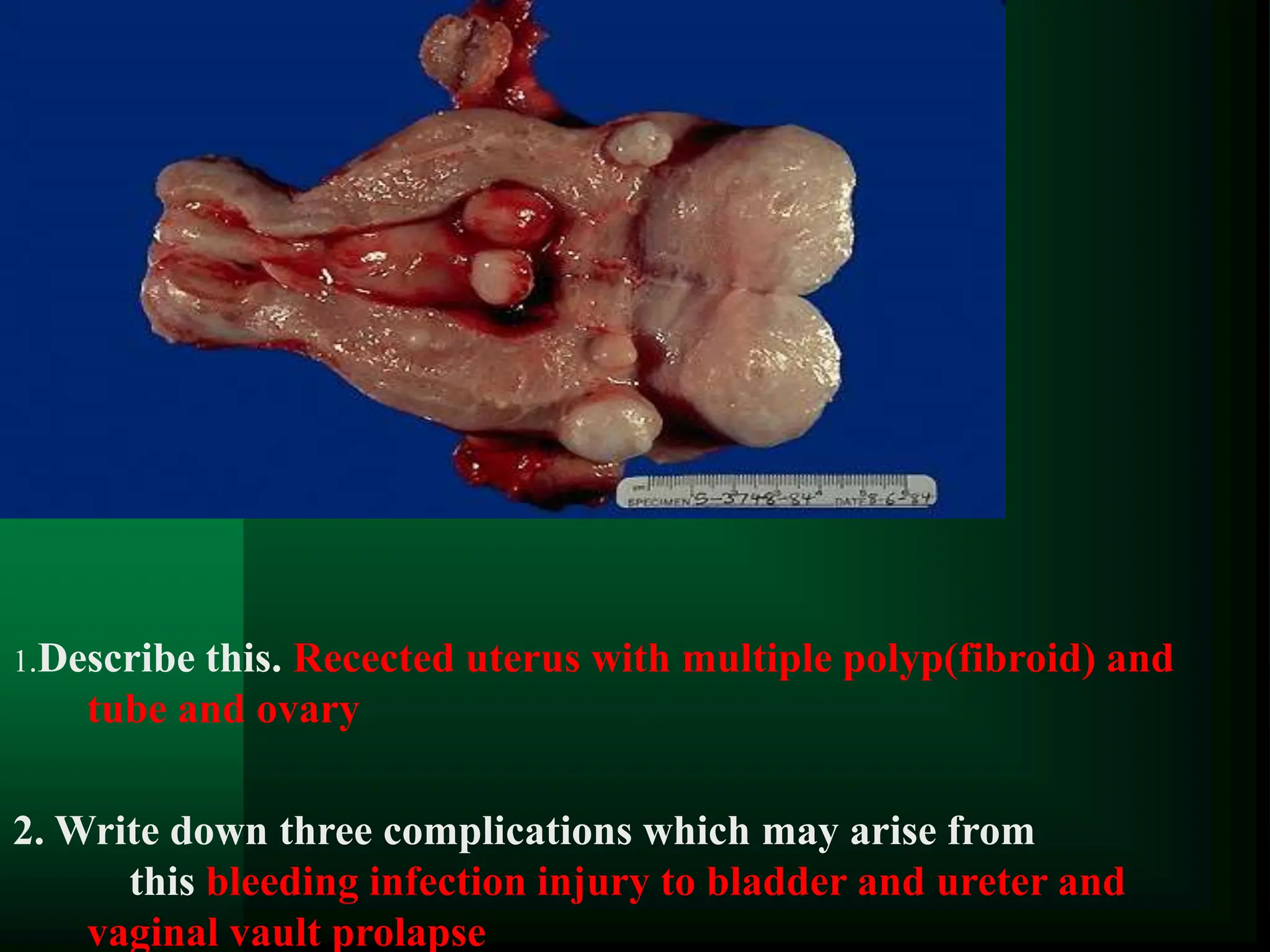 1.Describe this. Recected uterus with multiple polyp(fibroid) and
tube and ovary
2. Write down three complications which may arise from
this bleeding infection injury to bladder and ureter and
vaginal vault prolapse
 