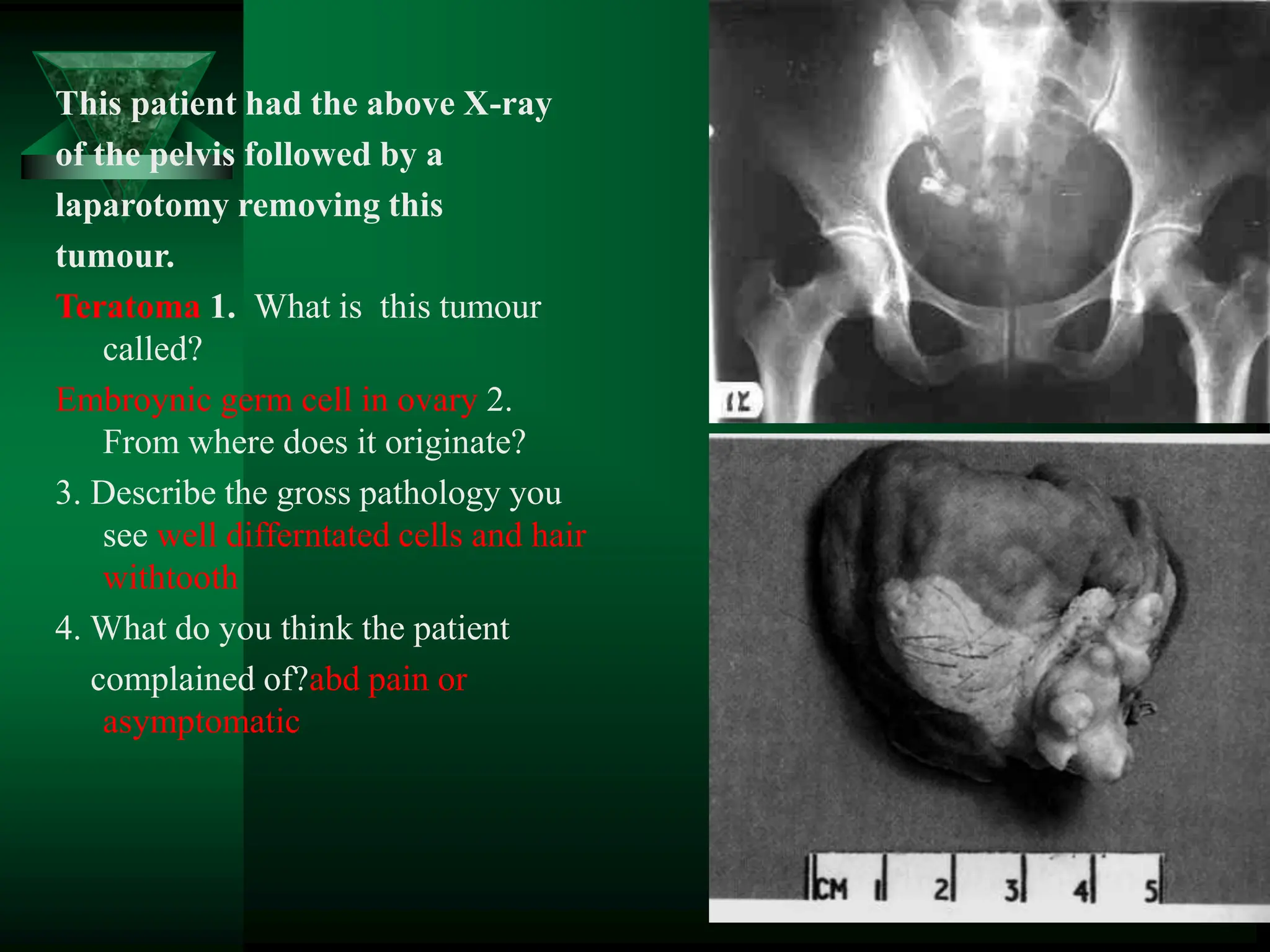 This patient had the above X-ray
of the pelvis followed by a
laparotomy removing this
tumour.
Teratoma 1. What is this tumour
called?
Embroynic germ cell in ovary 2.
From where does it originate?
3. Describe the gross pathology you
see well differntated cells and hair
withtooth
4. What do you think the patient
complained of?abd pain or
asymptomatic
 
