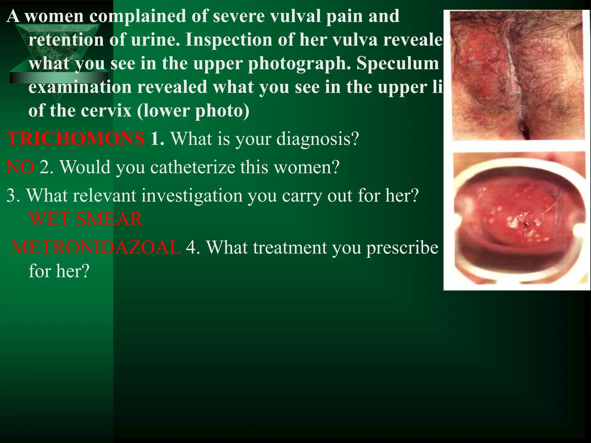 A women complained of severe vulval pain and
retention of urine. Inspection of her vulva revealed
what you see in the upper photograph. Speculum
examination revealed what you see in the upper lip
of the cervix (lower photo)
TRICHOMONS 1. What is your diagnosis?
NO 2. Would you catheterize this women?
3. What relevant investigation you carry out for her?
WET SMEAR
METRONIDAZOAL 4. What treatment you prescribe
for her?
 