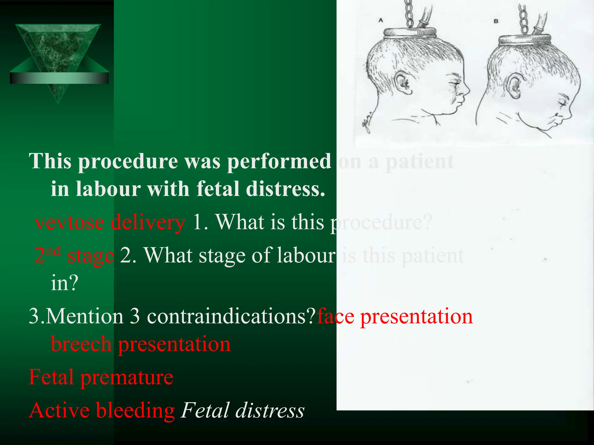 This procedure was performed on a patient
in labour with fetal distress.
vevtose delivery 1. What is this procedure?
2nd stage 2. What stage of labour is this patient
in?
3.Mention 3 contraindications?face presentation
breech presentation
Fetal premature
Active bleeding Fetal distress
 