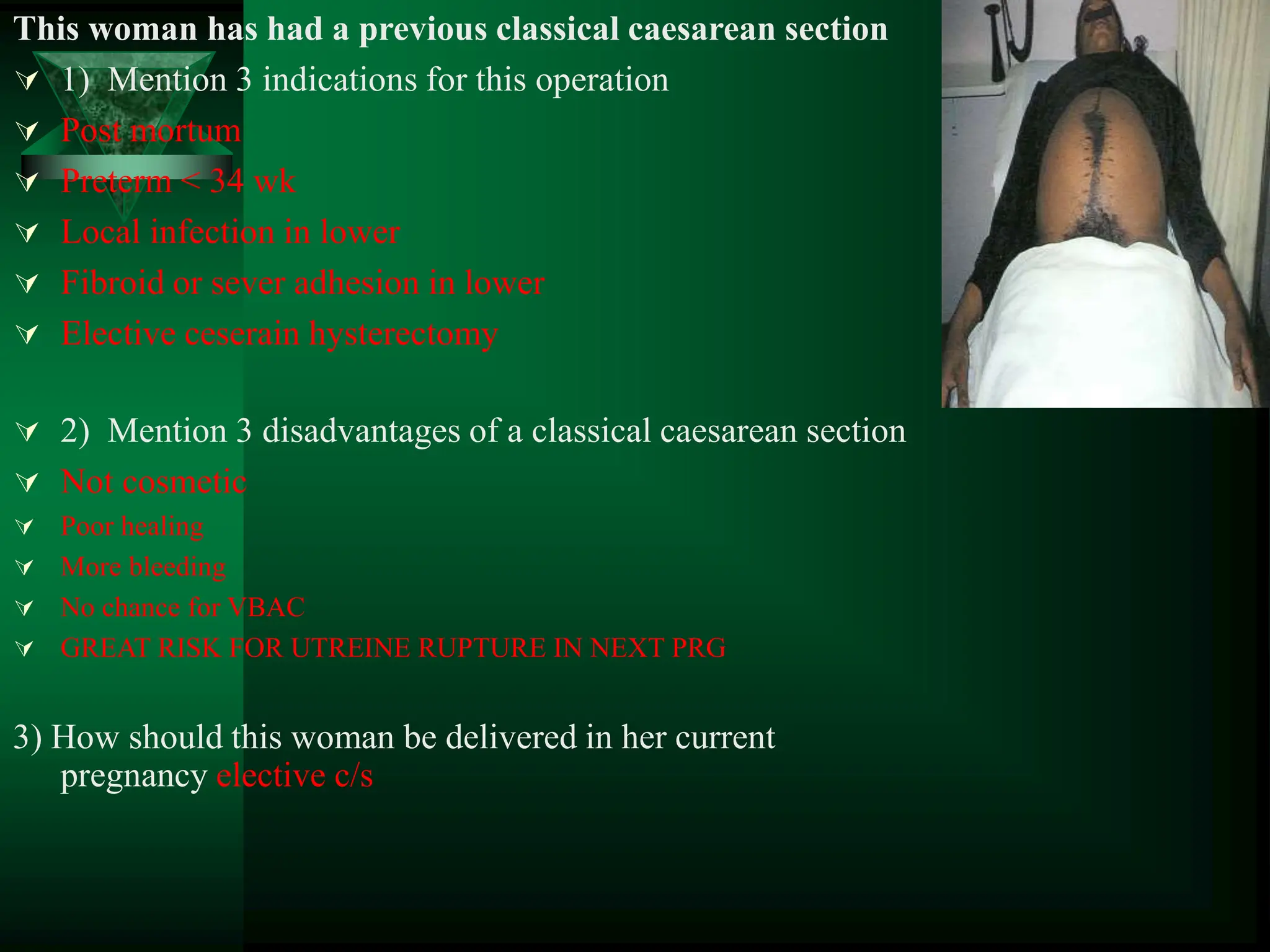 This woman has had a previous classical caesarean section
 1) Mention 3 indications for this operation
 Post mortum
 Preterm < 34 wk
 Local infection in lower
 Fibroid or sever adhesion in lower
 Elective ceserain hysterectomy
 2) Mention 3 disadvantages of a classical caesarean section
 Not cosmetic
 Poor healing
 More bleeding
 No chance for VBAC
 GREAT RISK FOR UTREINE RUPTURE IN NEXT PRG
3) How should this woman be delivered in her current
pregnancy elective c/s
 