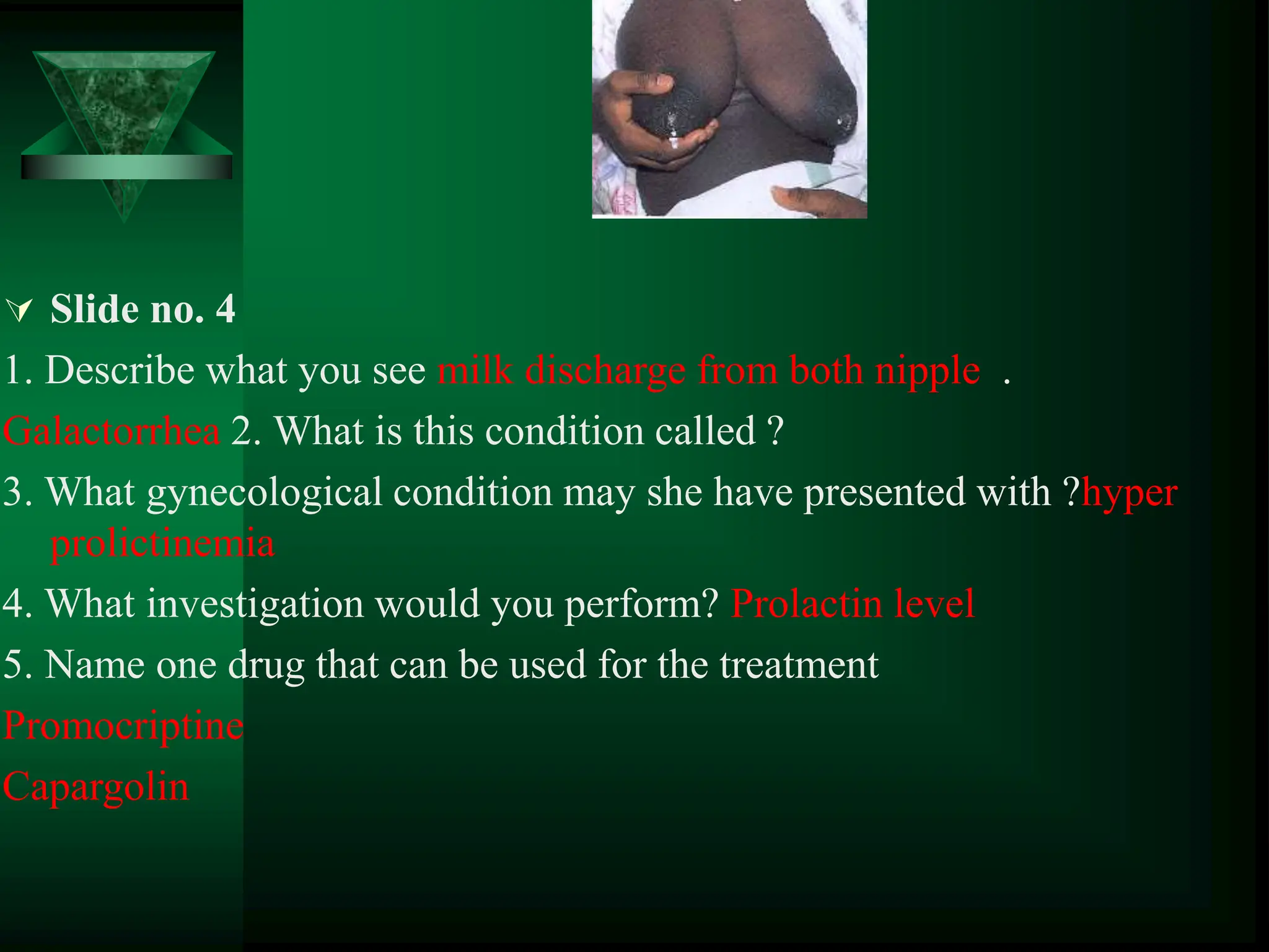  Slide no. 4
1. Describe what you see milk discharge from both nipple .
Galactorrhea 2. What is this condition called ?
3. What gynecological condition may she have presented with ?hyper
prolictinemia
4. What investigation would you perform? Prolactin level
5. Name one drug that can be used for the treatment
Promocriptine
Capargolin
 