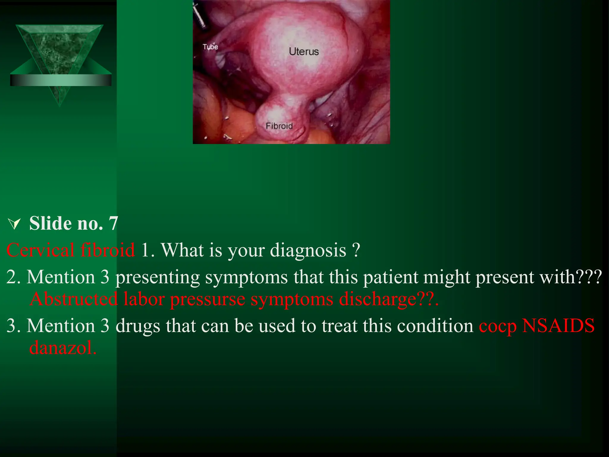 Slide no. 7
Cervical fibroid 1. What is your diagnosis ?
2. Mention 3 presenting symptoms that this patient might present with???
Abstructed labor pressurse symptoms discharge??.
3. Mention 3 drugs that can be used to treat this condition cocp NSAIDS
danazol.
 