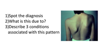 1)Spot the diagnosis
2)What is this due to?
3)Describe 3 conditions
associated with this pattern
 