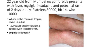 22 year old from Mumbai no comorbids presents
with fever, myalgia, headache and petechial rash
of 2 days in July. Platelets 80000, hb 14, wbc
10000.
• What are the common tropical
fevers in india?
• How would you investigate a
patient with tropical fever?
• Empiric treatment?
 