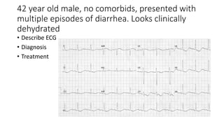 42 year old male, no comorbids, presented with
multiple episodes of diarrhea. Looks clinically
dehydrated
• Describe ECG
• Diagnosis
• Treatment
 