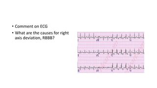 • Comment on ECG
• What are the causes for right
axis deviation, RBBB?
 