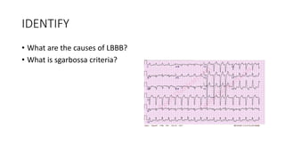IDENTIFY
• What are the causes of LBBB?
• What is sgarbossa criteria?
 