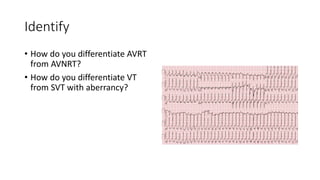 Identify
• How do you differentiate AVRT
from AVNRT?
• How do you differentiate VT
from SVT with aberrancy?
 