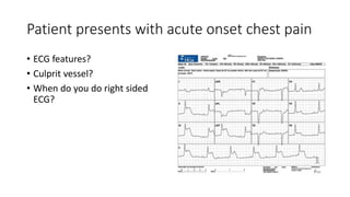 Patient presents with acute onset chest pain
• ECG features?
• Culprit vessel?
• When do you do right sided
ECG?
 
