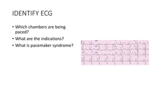 IDENTIFY ECG
• Which chambers are being
paced?
• What are the indications?
• What is pacemaker syndrome?
 