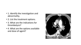 • 1. Identify the investigation and
abnormality.
• 2. List the treatment options.
• 3. What are the indications for
thrombolysis?
• 4. What are the options available
and dose of agent?
 