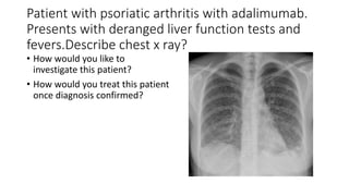 Patient with psoriatic arthritis with adalimumab.
Presents with deranged liver function tests and
fevers.Describe chest x ray?
• How would you like to
investigate this patient?
• How would you treat this patient
once diagnosis confirmed?
 