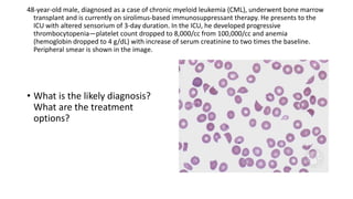 48-year-old male, diagnosed as a case of chronic myeloid leukemia (CML), underwent bone marrow
transplant and is currently on sirolimus-based immunosuppressant therapy. He presents to the
ICU with altered sensorium of 3-day duration. In the ICU, he developed progressive
thrombocytopenia—platelet count dropped to 8,000/cc from 100,000/cc and anemia
(hemoglobin dropped to 4 g/dL) with increase of serum creatinine to two times the baseline.
Peripheral smear is shown in the image.
• What is the likely diagnosis?
What are the treatment
options?
 