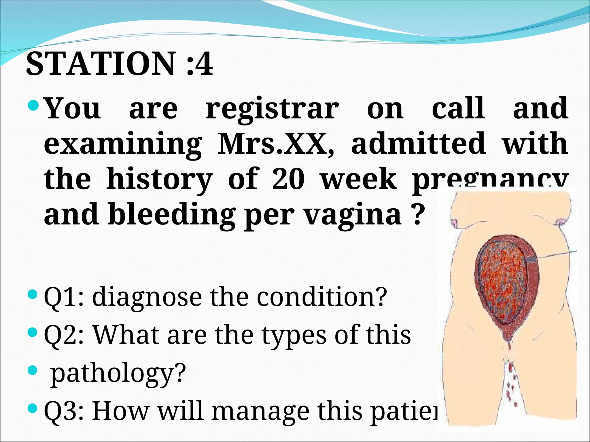 STATION :4
You are registrar on call and
examining Mrs.XX, admitted with
the history of 20 week pregnancy
and bleeding per vagina ?
 Q1: diagnose the condition?
 Q2: What are the types of this
 pathology?
 Q3: How will manage this patients?
 