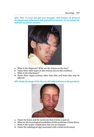 Neurology 117
Q24. This 7½-year-old girl was brought with history of delayed
developmental milestones and generalized seizures. As an infant she
had had myoclonic seizures.
a. What is the diagnosis? What are the lesions on the face?
b. Name three other types of skin lesions seen in this condition.
c. What is the inheritance?
d. Name three organ systems other than skin and brain that may be
affected.
Q25. Study the image of the 10-year-old child and answer the questions.
a. Name the lesion and the syndrome that it forms a part of.
b. What are the neurological morbidities of this syndrome (Name three).
c. What is the ocular complication that can accompany?
d. Name the radiological sign associated with cranial involvement.
 