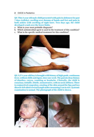2 OSCE in Pediatrics
Q2. This 3-year-old male child presented with pain in abdomen for past
7 days (colicky), swelling over dorsum of hands and feet and pain in
both ankles with swelling of right knee. Two days ago, the child
developed a rash over the lower limbs.
a. What is your most probable diagnosis?
b. Which antimicrobial agent is used in the treatment of this condition?
c. What is the specific medical treatment for this condition?
Q3. A 2 ½-year-old boy is brought with history of high grade, continuous
fever, without chills and rigors, since one week. The parents deny history
of diarrhea, coryza, vomiting or headache. Clinically, the child is
conscious, irritable, febrile, normotensive, with no neck stiffness. There
is conjunctival congestion, crusting of the skin around the lips and two
discrete left sided cervical lymph nodes measuring 2 cm in size. Systemic
examination is normal. The photograph of the child is shown.
 