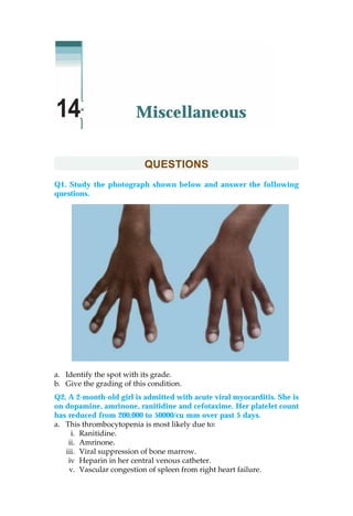 QUESTIONS
Q1. Study the photograph shown below and answer the following
questions.
a. Identify the spot with its grade.
b. Give the grading of this condition.
Q2. A 2-month-old girl is admitted with acute viral myocarditis. She is
on dopamine, amrinone, ranitidine and cefotaxime. Her platelet count
has reduced from 200,000 to 50000/cu mm over past 5 days.
a. This thrombocytopenia is most likely due to:
i. Ranitidine.
ii. Amrinone.
iii. Viral suppression of bone marrow.
iv Heparin in her central venous catheter.
v. Vascular congestion of spleen from right heart failure.
Miscellaneous14
 