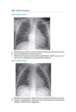 180 OSCE in Pediatrics
Q16. Cardiac device.
a. Identify the procedure, where the device shown in this X-ray is used.
b. List two indications of this procedure.
c. What is the long-term non-cardiac complication, which may occur, if
the device is not placed in asymptomatic children?
Q17. Cardiac device.
a. Identify the procedure, where the device shown in this X-ray is used.
b. List five complications, which may occur, if the device is not placed in
children with the above diagnosis.
 