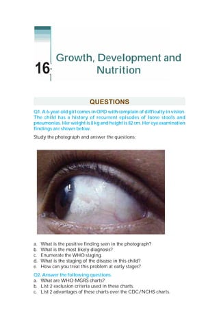 QUESTIONS
Q1. A 6-year-old girl comes in OPD with complain of difficulty in vision.
The child has a history of recurrent episodes of loose stools and
pneumonias. Her weight is 8 kg and height is 82 cm. Her eye examination
findings are shown below.
Study the photograph and answer the questions:
a. What is the positive finding seen in the photograph?
b. What is the most likely diagnosis?
c. Enumerate the WHO staging.
d. What is the staging of the disease in this child?
e. How can you treat this problem at early stages?
Q2. Answer the following questions.
a. What are WHO-MGRS charts?
b. List 2 exclusion criteria used in these charts.
c. List 2 advantages of these charts over the CDC/NCHS charts.
Growth, Development and
Nutrition16
 