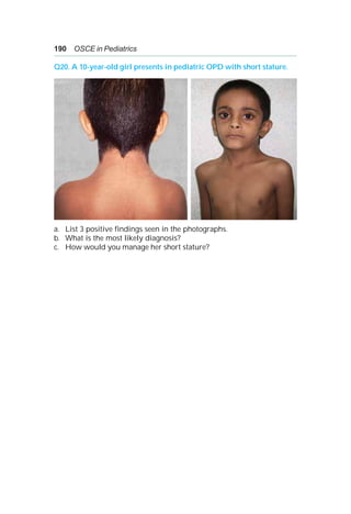 190 OSCE in Pediatrics
Q20. A 10-year-old girl presents in pediatric OPD with short stature.
a. List 3 positive findings seen in the photographs.
b. What is the most likely diagnosis?
c. How would you manage her short stature?
 