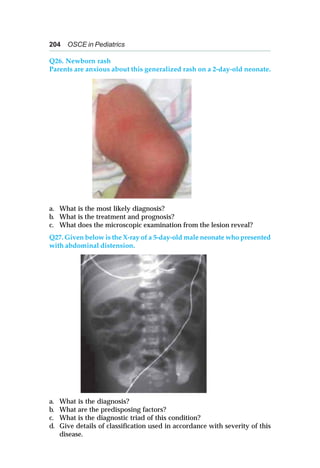 204 OSCE in Pediatrics
Q26. Newborn rash
Parents are anxious about this generalized rash on a 2-day-old neonate.
a. What is the most likely diagnosis?
b. What is the treatment and prognosis?
c. What does the microscopic examination from the lesion reveal?
Q27. Given below is the X-ray of a 5-day-old male neonate who presented
with abdominal distension.
a. What is the diagnosis?
b. What are the predisposing factors?
c. What is the diagnostic triad of this condition?
d. Give details of classification used in accordance with severity of this
disease.
 