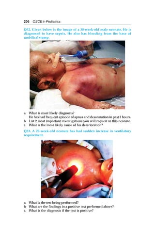 206 OSCE in Pediatrics
Q32. Given below is the image of a 30-week-old male neonate. He is
diagnosed to have sepsis. He also has bleeding from the base of
umbilical stump.
a. What is most likely diagnosis?
He has had frequent episode of apnea and desaturation in past 2 hours.
b. List 2 most important investigations you will request in this neonate.
c. What is the most likely cause of his deterioration?
Q33. A 29-week-old neonate has had sudden increase in ventilatory
requirement.
a. What is the test being performed?
b. What are the findings in a positive test performed above?
c. What is the diagnosis if the test is positive?
 