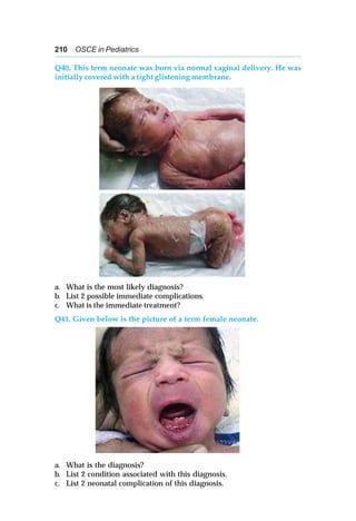 210 OSCE in Pediatrics
Q40. This term neonate was born via normal vaginal delivery. He was
initially covered with a tight glistening membrane.
a. What is the most likely diagnosis?
b. List 2 possible immediate complications.
c. What is the immediate treatment?
Q41. Given below is the picture of a term female neonate.
a. What is the diagnosis?
b. List 2 condition associated with this diagnosis.
c. List 2 neonatal complication of this diagnosis.
 