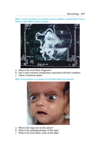 Neonatology 211
Q42. A term newborn was noted to have audible cranial bruit. Given
below is the MRA of this neonate.
a. What is the most likely diagnosis?
b. List 2 most common complication associated with this condition.
c. Name 1 treatment option.
Q43. Given below is a picture of a 20-day-old term neonate.
a. What is the sign seen in this photo?
b. What is the pathophysiology of this sign?
c. What is the most likely cause of this sign?
 
