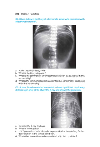 226 OSCE in Pediatrics
Q6. Given below is the X-ray of a term male infant who presented with
abdominal distention.
a. Name the abnormality seen.
b. What is the likely diagnosis?
c. What is the commonest chromosomal aberration associated with this
abnormality?
d. What is the commonest upper gastrointestinal abnormality associated
with this abnormality?
Q7. A term female newborn was noted to have significant respiratory
distress soon after birth. Study the X-ray and answer the questions.
a. Describe the X-ray findings.
b. What is the diagnosis?
c. List 2 precautions to be taken during resuscitation to avoid any further
deterioration in the clinical condition.
d. What other anomalies can be associated with this condition?
 
