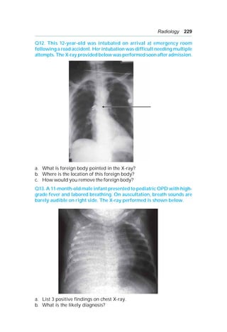 Radiology 229
Q12. This 12-year-old was intubated on arrival at emergency room
following a road accident. Her intubation was difficult needing multiple
attempts. The X-ray provided below was performed soon after admission.
a. What is foreign body pointed in the X-ray?
b. Where is the location of this foreign body?
c. How would you remove the foreign body?
Q13. A 11-month-old male infant presented to pediatric OPD with high-
grade fever and labored breathing. On auscultation, breath sounds are
barely audible on right side. The X-ray performed is shown below.
a. List 3 positive findings on chest X-ray.
b. What is the likely diagnosis?
 