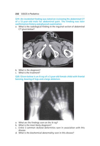 232 OSCE in Pediatrics
Q19. An incidental finding was noted on reviewing the abdominal CT
of a 12-year-old male for abdominal pain. The finding was later
confirmed on history and physical examination.
a. What is the radiological finding in the inguinal section of abdominal
CT given below?
b. What is the diagnosis?
c. What is the treatment?
Q20. Given below is an X-ray of a 3-year-old female child with frontal
bossing, bowing of legs and a large abdomen.
a. What are the findings seen on the X-ray?
b. What is the most likely diagnosis?
c. Enlist 3 common skeletal deformities seen in association with this
disease.
d. What is the biochemical abnormality seen in this disease?
 