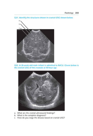Radiology 233
Q21. Identify the structures shown in cranial USG shown below.
Q22. A 28-week-old male infant is admitted to NICU. Given below is
the cranial USG of this neonate at 48 hour age.
a. What are the cranial ultrasound findings?
b. What is the complete diagnosis?
c. How do you stage the disease based on cranial USG?
 