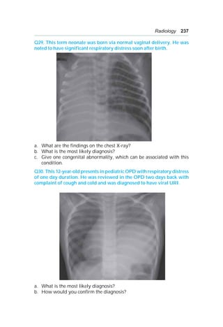 Radiology 237
Q29. This term neonate was born via normal vaginal delivery. He was
noted to have significant respiratory distress soon after birth.
a. What are the findings on the chest X-ray?
b. What is the most likely diagnosis?
c. Give one congenital abnormality, which can be associated with this
condition.
Q30. This 12-year-old presents in pediatric OPD with respiratory distress
of one day duration. He was reviewed in the OPD two days back with
complaint of cough and cold and was diagnosed to have viral URI.
a. What is the most likely diagnosis?
b. How would you confirm the diagnosis?
 