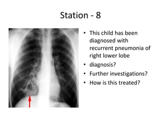 Station - 8
• This child has been
diagnosed with
recurrent pneumonia of
right lower lobe
• diagnosis?
• Further investigations?
• How is this treated?
 