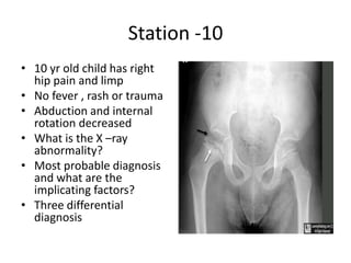 Station -10
• 10 yr old child has right
hip pain and limp
• No fever , rash or trauma
• Abduction and internal
rotation decreased
• What is the X –ray
abnormality?
• Most probable diagnosis
and what are the
implicating factors?
• Three differential
diagnosis
 