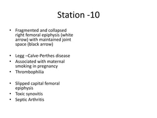 Station -10
• Fragmented and collapsed
right femoral epiphysis (white
arrow) with maintained joint
space (black arrow)
• Legg –Calve-Perthes disease
• Associated with maternal
smoking in pregnancy
• Thrombophilia
• Slipped capital femoral
epiphysis
• Toxic synovitis
• Septic Arthritis
 