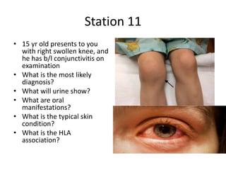 Station 11
• 15 yr old presents to you
with right swollen knee, and
he has b/l conjunctivitis on
examination
• What is the most likely
diagnosis?
• What will urine show?
• What are oral
manifestations?
• What is the typical skin
condition?
• What is the HLA
association?
 