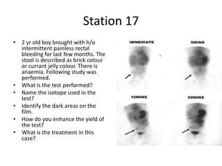 Station 17
• 2 yr old boy brought with h/o
intermittent painless rectal
bleeding for last few months. The
stool is described as brick colour
or currant jelly colour. There is
anaemia. Following study was
performed.
• What is the test performed?
• Name the isotope used in the
test?
• Identify the dark areas on the
film.
• How do you enhance the yield of
the test?
• What is the treatment in this
case?
 