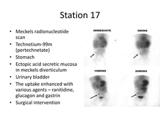Station 17
• Meckels radionucleotide
scan
• Technetium-99m
(pertechnetate)
• Stomach
• Ectopic acid secretic mucosa
in meckels diverticulum
• Urinary bladder
• The uptake enhanced with
various agents – ranitidine,
glucagon and gastrin
• Surgical intervention
 