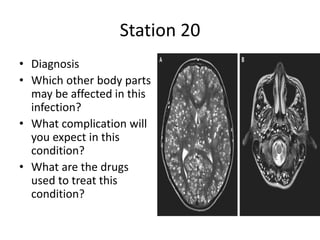 Station 20
• Diagnosis
• Which other body parts
may be affected in this
infection?
• What complication will
you expect in this
condition?
• What are the drugs
used to treat this
condition?
 