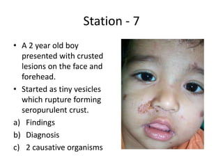 Station - 7
• A 2 year old boy
presented with crusted
lesions on the face and
forehead.
• Started as tiny vesicles
which rupture forming
seropurulent crust.
a) Findings
b) Diagnosis
c) 2 causative organisms
 