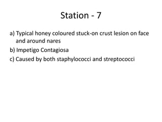 Station - 7
a) Typical honey coloured stuck-on crust lesion on face
and around nares
b) Impetigo Contagiosa
c) Caused by both staphylococci and streptococci
 