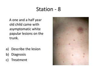 Station - 8
A one and a half year
old child came with
asymptomatic white
papular lesions on the
trunk.
a) Describe the lesion
b) Diagnosis
c) Treatment
 