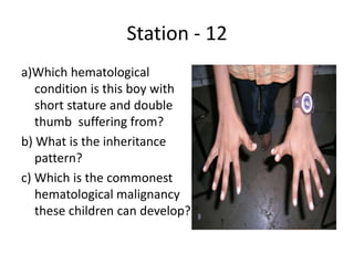 Station - 12
a)Which hematological
condition is this boy with
short stature and double
thumb suffering from?
b) What is the inheritance
pattern?
c) Which is the commonest
hematological malignancy
these children can develop?
 