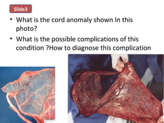 • What is the cord anomaly shown In this
photo?
• What is the possible complications of this
condition ?How to diagnose this complication
Slide3
 