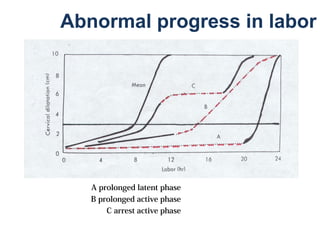 A prolonged latent phase
B prolonged active phase
C arrest active phase
Abnormal progress in labor
 