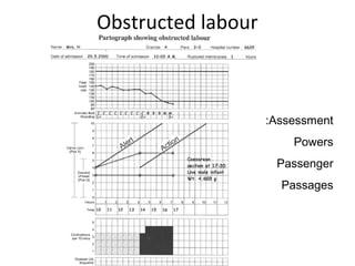 Obstructed labour
Assessment:
Powers
Passenger
Passages
 