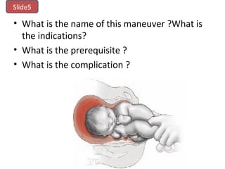 • What is the name of this maneuver ?What is
the indications?
• What is the prerequisite ?
• What is the complication ?
Slide5
 